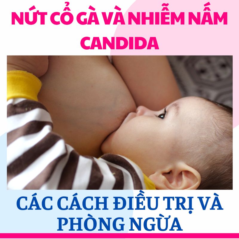 Nứt cổ gà và nhiễm nấm candida cahcs điều trị